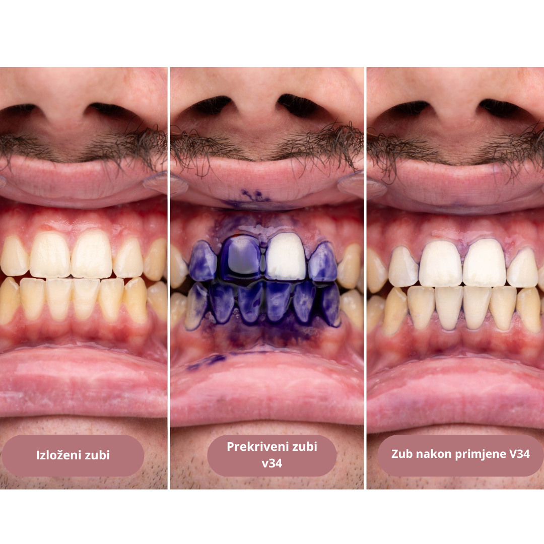 PURPLE V34 - Sredstvo za izbjeljivanje zubi